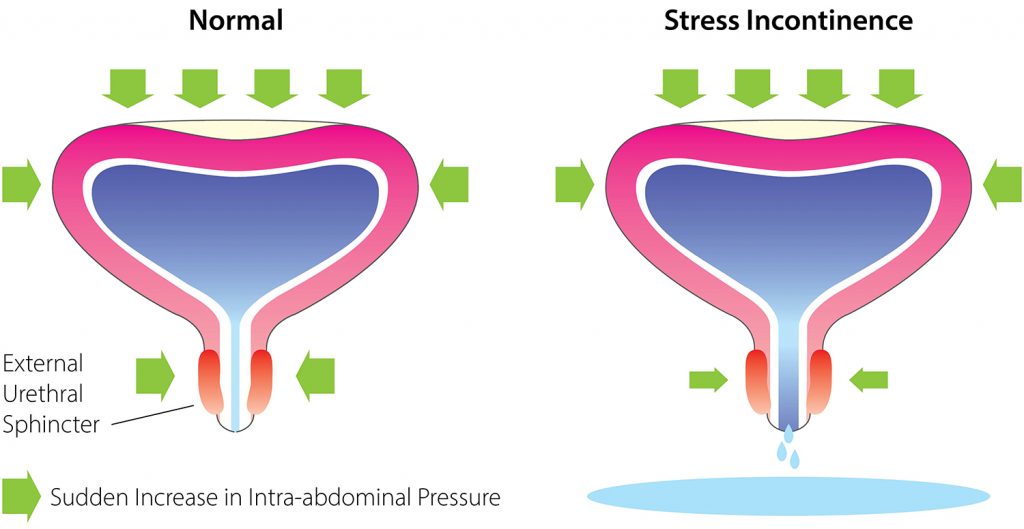 What is Stress Urinary Incontinence (SUI)?